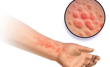 manifestations of schistosomosis in people
