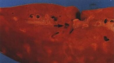 what parasites can live in the human liver